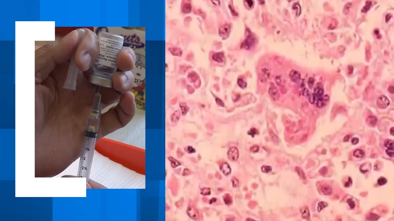 SCDPH confirms measles case in Beaufort County; exposure locations identified